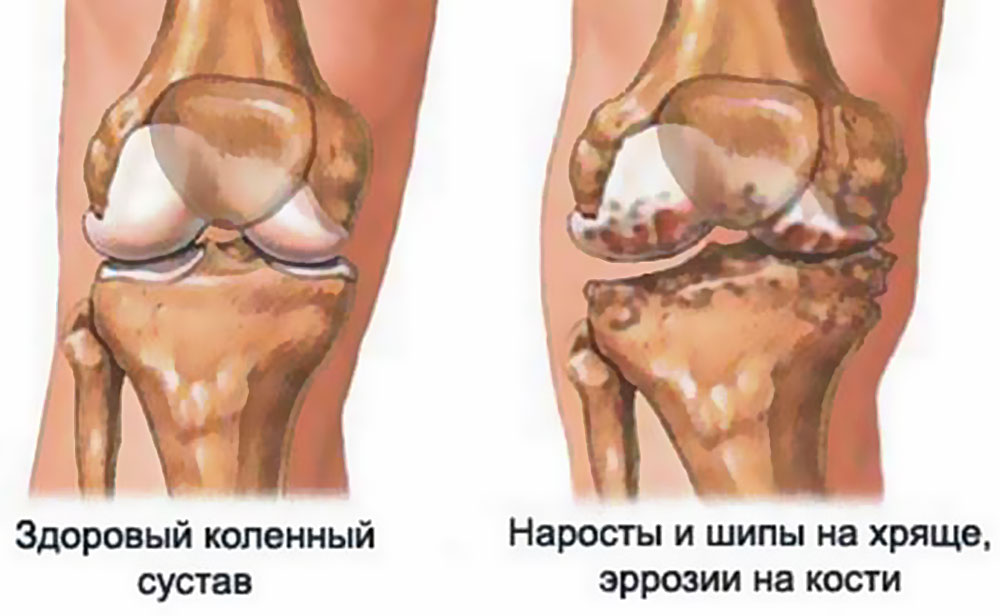 Хондросаркома