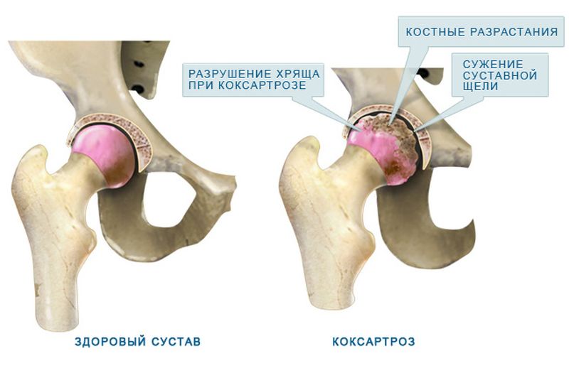 Схема коксартроза