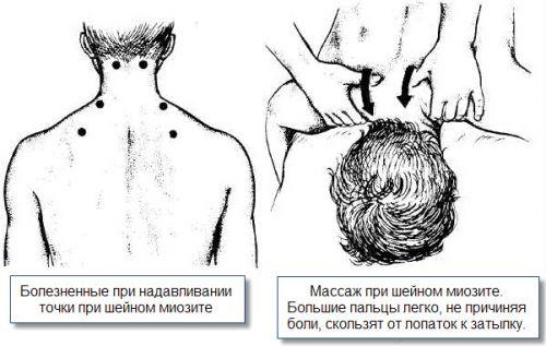 Массаж при шейном миозите Массаж при шейном миозите