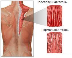 Миозит - воспаление мышц Миозит - воспаление мышц