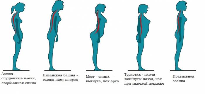 Нарушение осанки при сколиозе