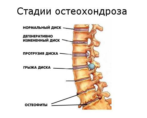 Стадии остеохондроза