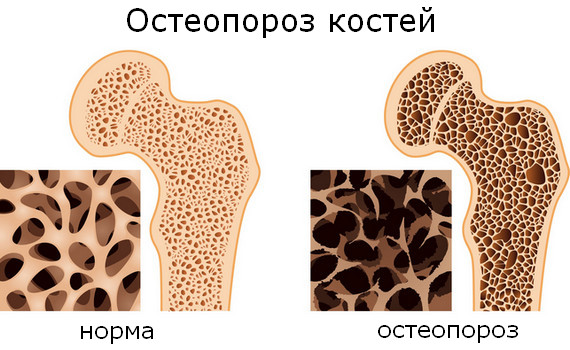 Остеопороз костей
