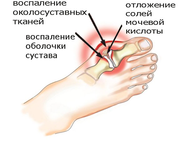 Схема подагры