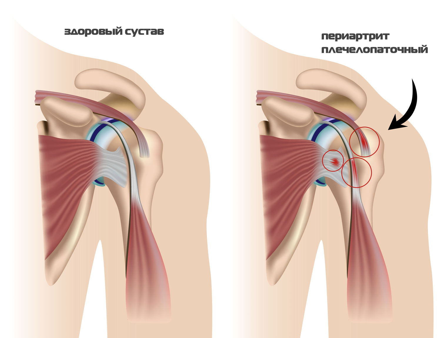 Схема плечелопаточного периартрита