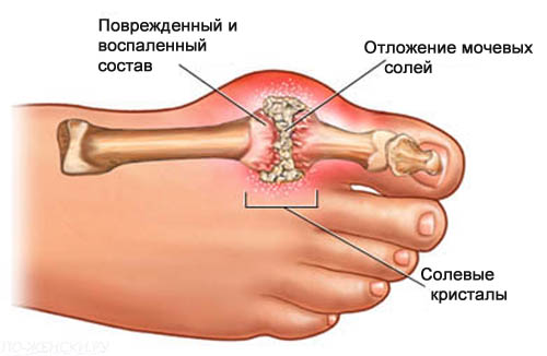 Схема подагры