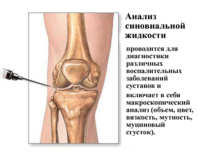 Анализ синовидной жидкости