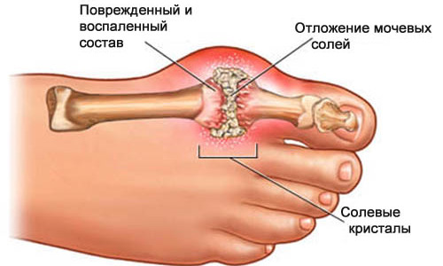 Схема подагры