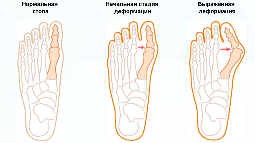 Стадии подагры