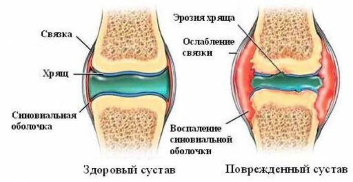 Изменения в суставе при полиартрите