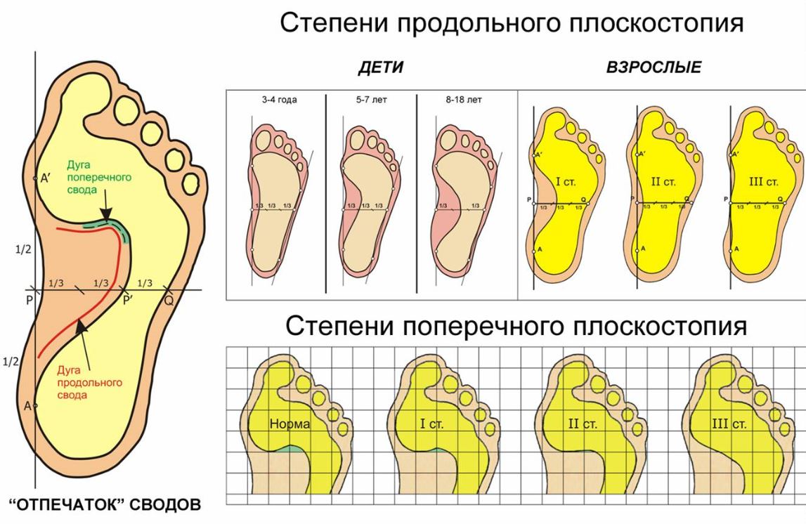 Плоскостопие - причина бурсита