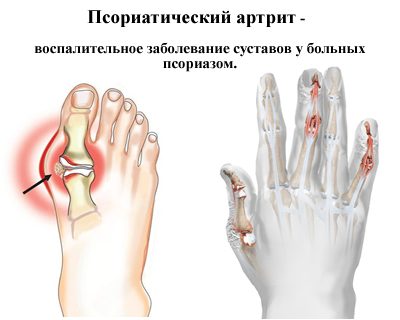 Схема псориатического артрита
