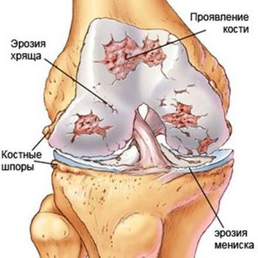 Схема артроза коленного сустава