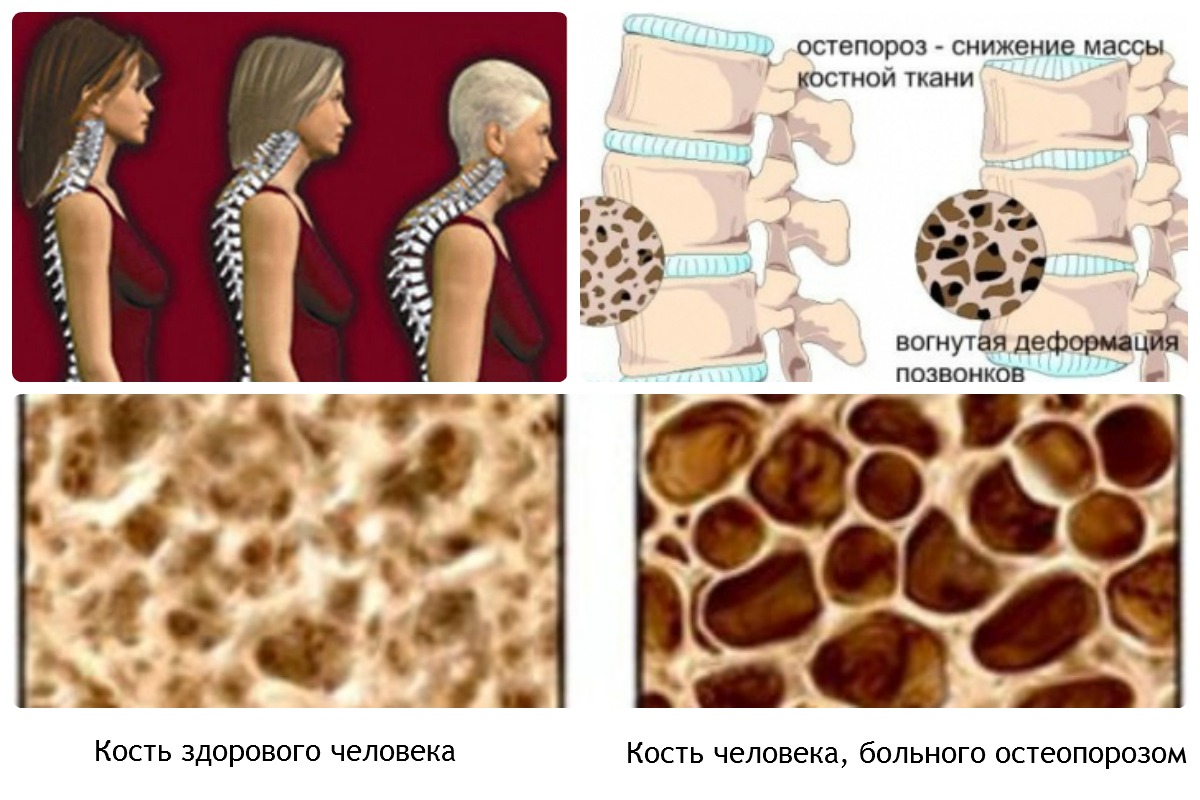 Сравнение остеопороза 