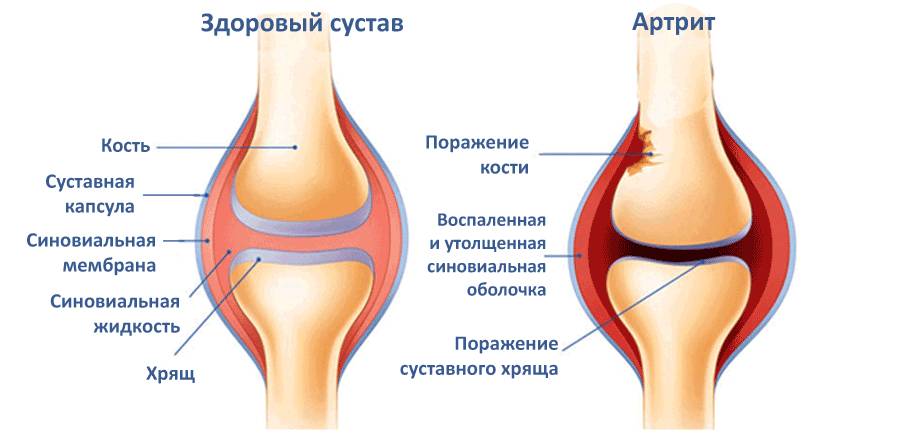 Схема артрита