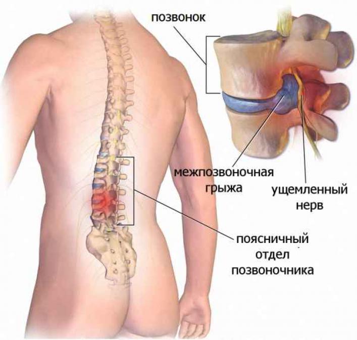 Схема межпозвоночной грыжи