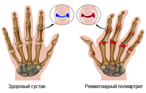 Схема ревматоидного полиартрита