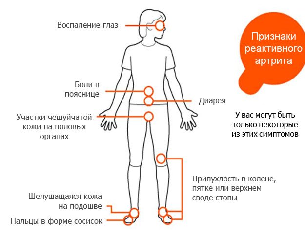 Основные симптомы реактивного артрита