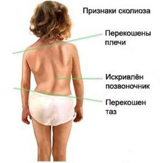 Основные симптомы сколиоза