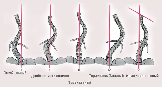 Формы сколиоза