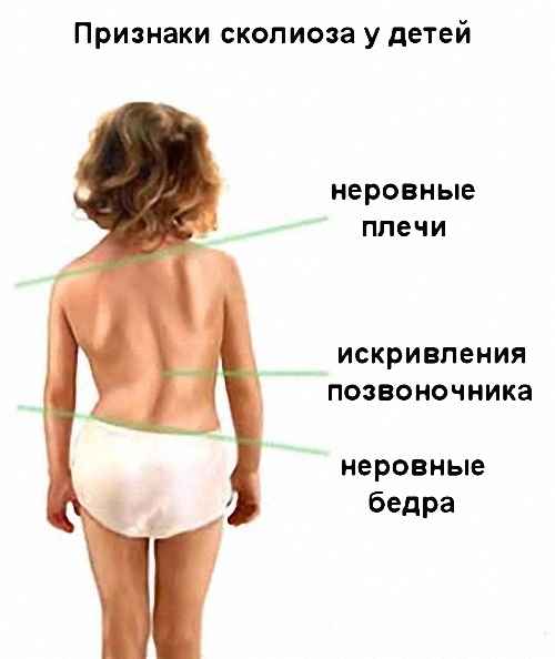 Признаки сколиоза позвоночника