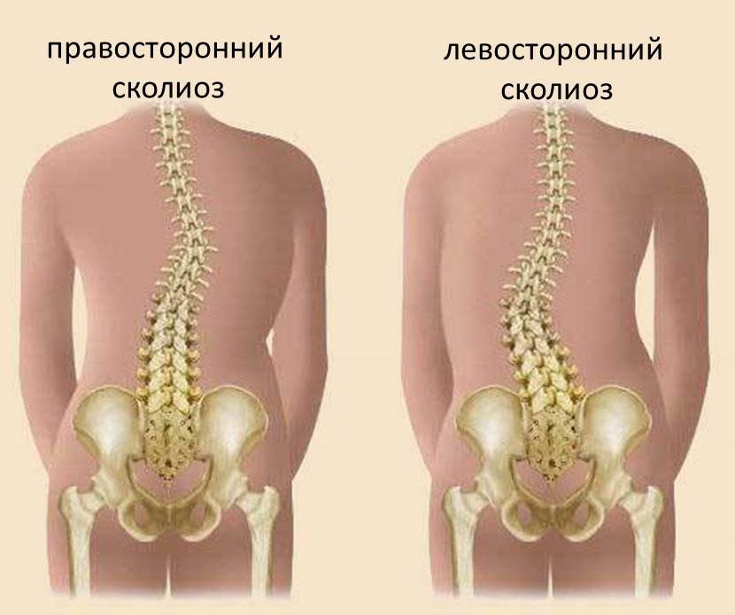 Основные виды сколиоза