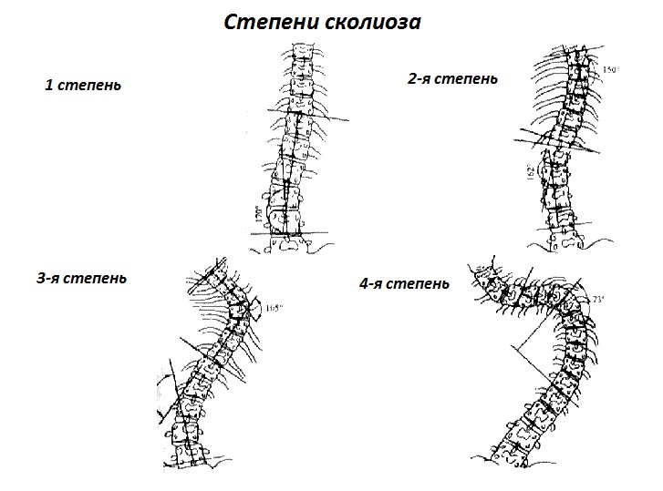 Степени сколиоза