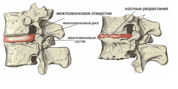 Схема спондилеза