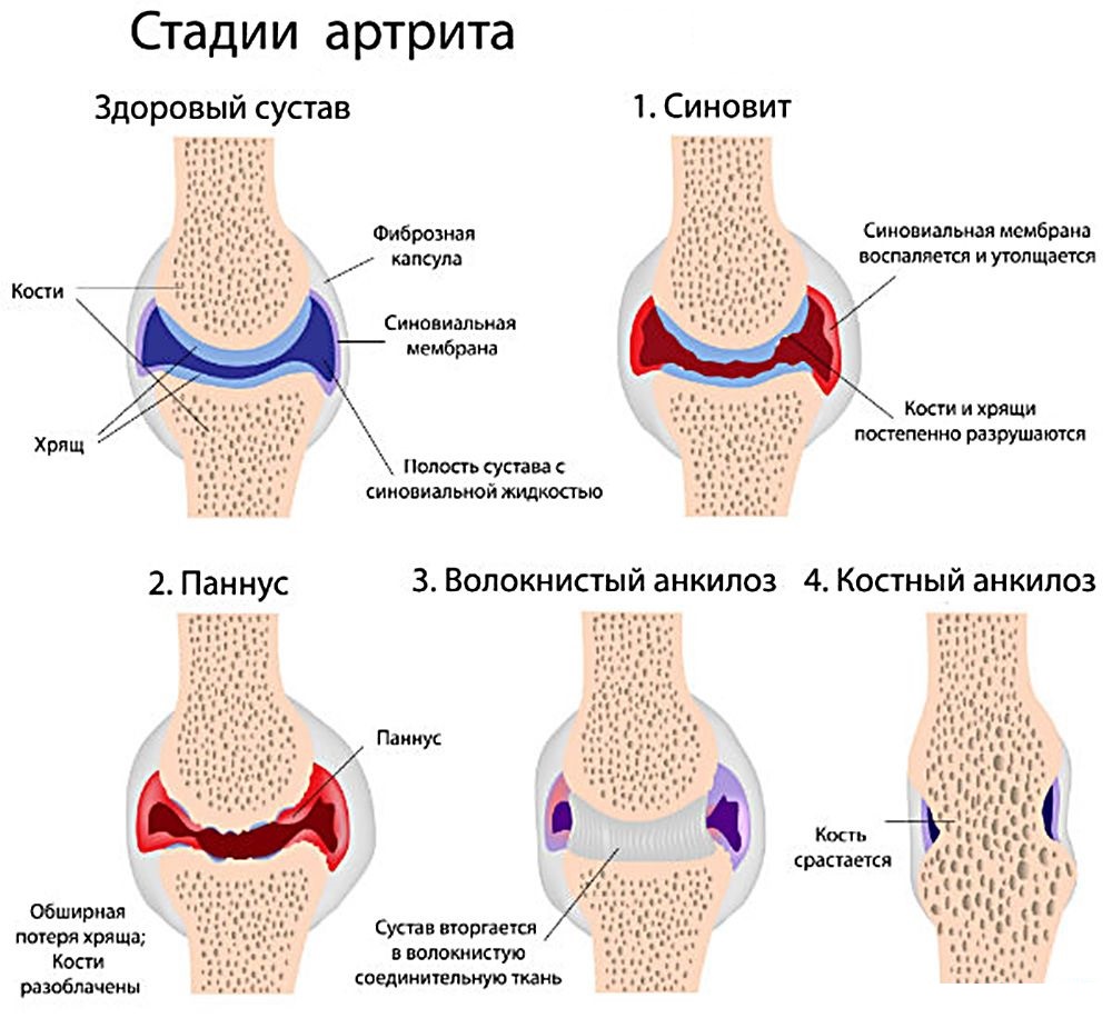Стадии артрита