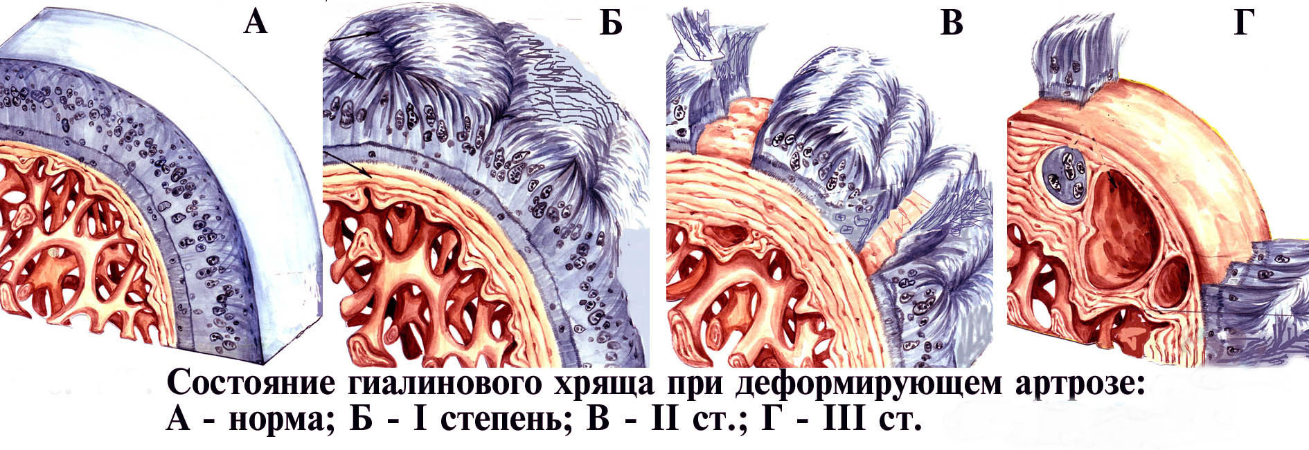 Стадии артроза
