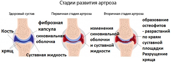 Стадии артроза