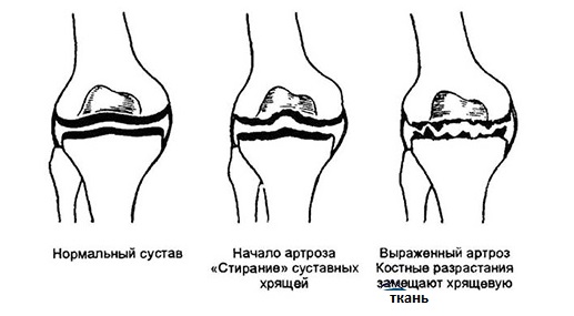 Стадии артроза