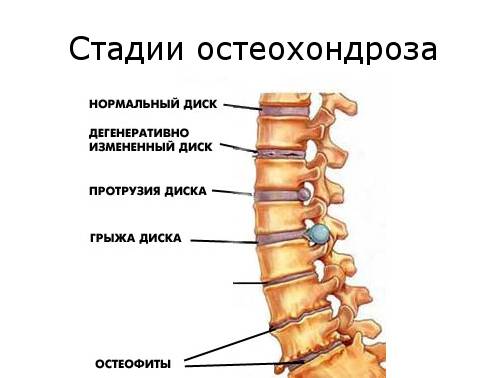 Стадии остеохондроза
