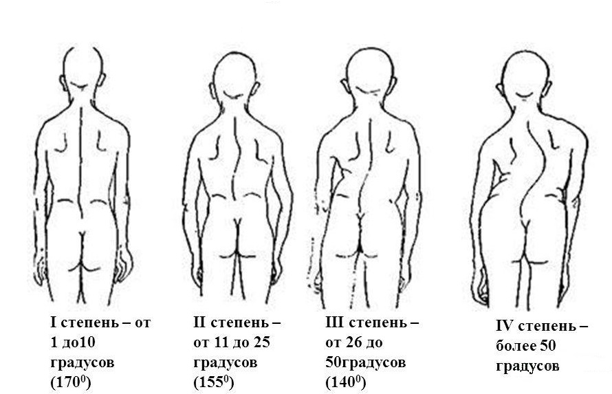 Степени сколиоза