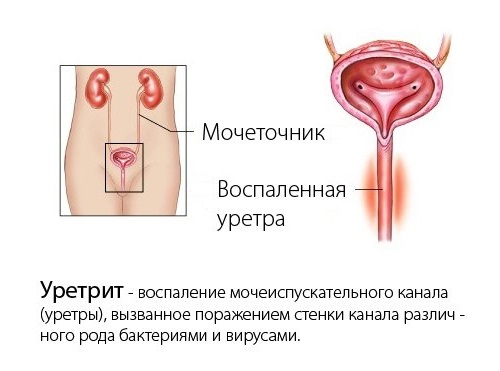 Схема уретрита