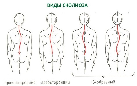 Виды сколиоза