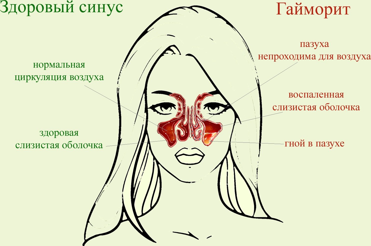Проявления гайморита