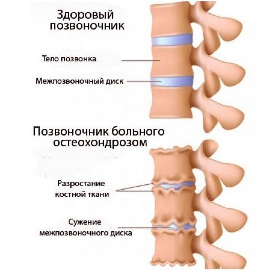 Деформация позвонков при остеохондрозе