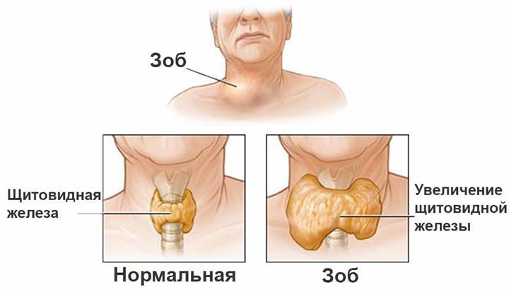 Как выглядит зоб щитовидной железы