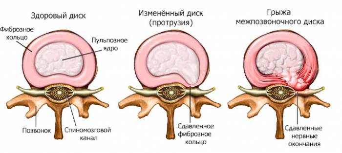 Возникновение грыжи