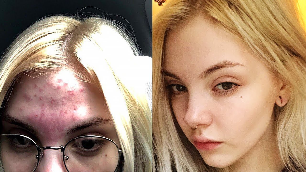 Эффект "до" и "после" применения препарата Зинерит от прыщей на лице
