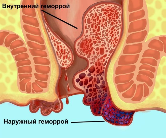 Лечение геморроя Метрогил гелем