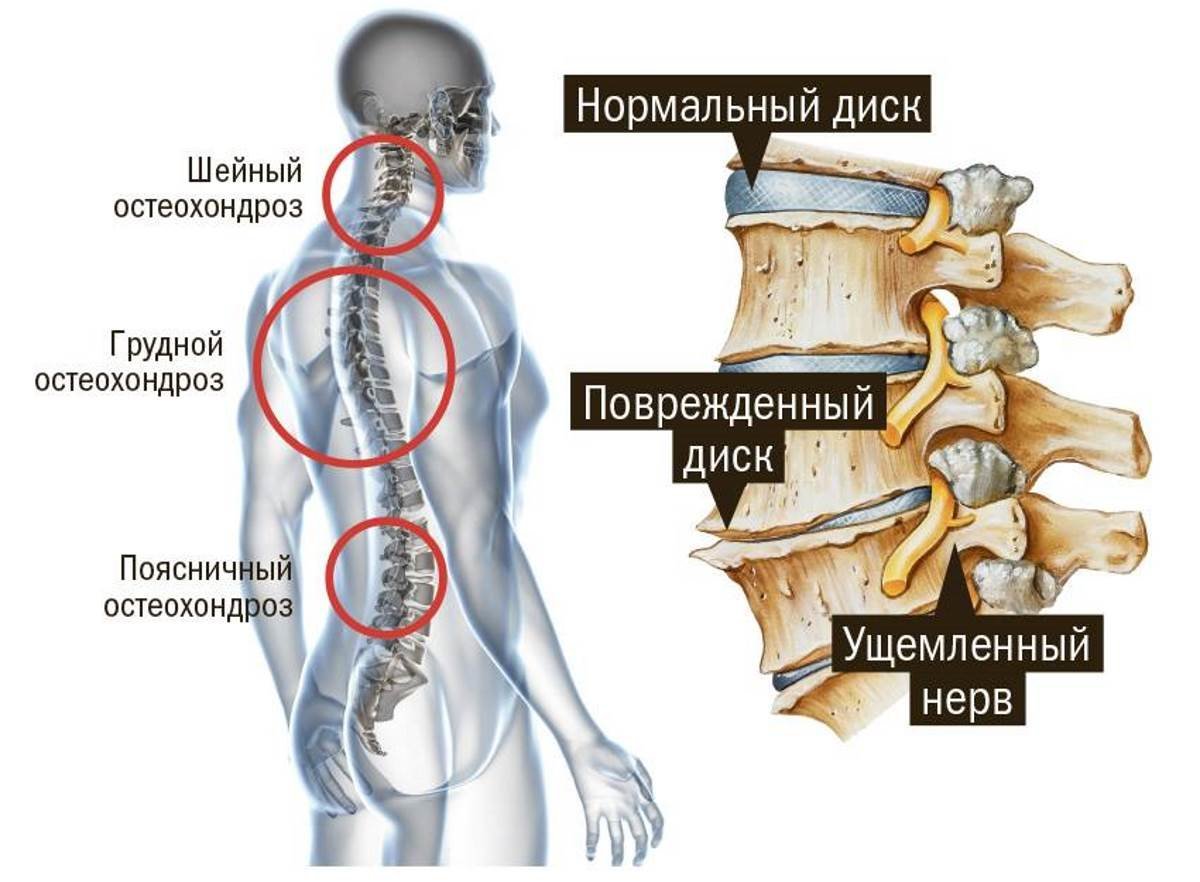 Виды остеохондроза