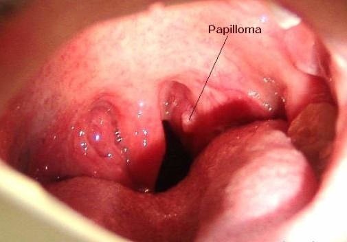 papilloma-vo-rtu