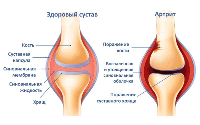 Причины развития артрита 