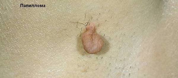prostaya-papilloma