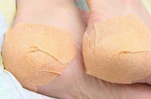 Компресс из живицы кедровой на мозоли