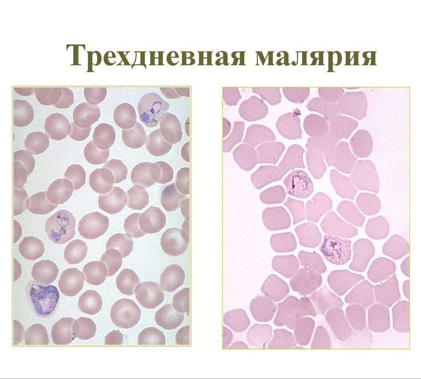 Трёхдневная малярия