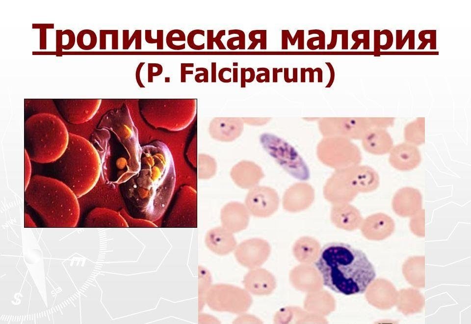 Тропическая малярия