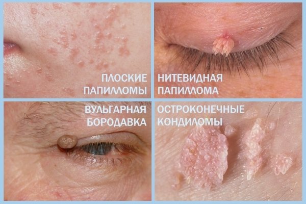 Виды папиллом